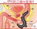 A-One - Procto Vibrating Tip Anal Plug photo-3